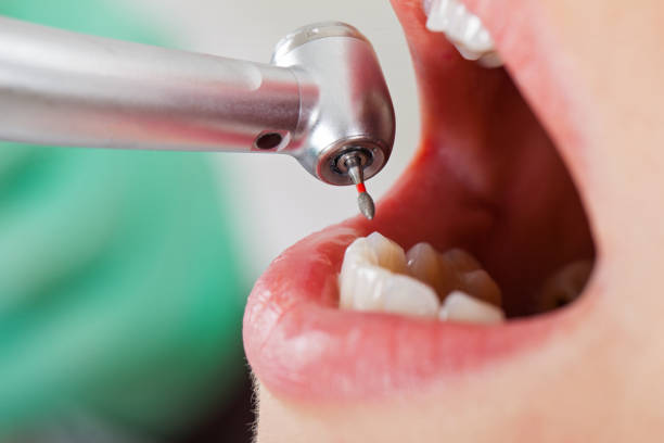 Best Emergency Tooth Extraction in Lake Park, GA